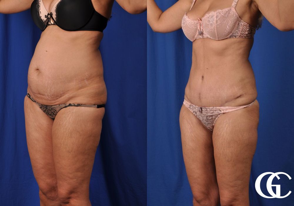 Tummy Tuck - Thumbnail 3