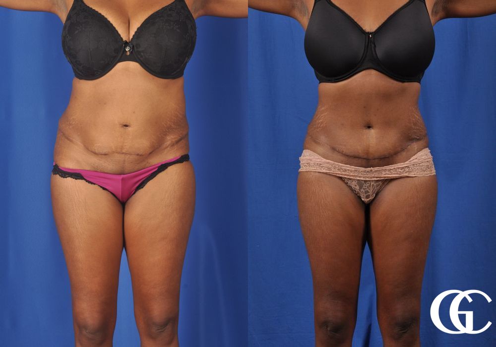 Tummy Tuck - Case 7016