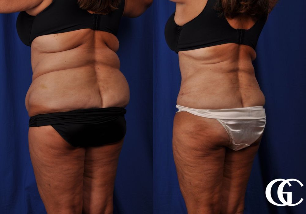 Tummy Tuck - Thumbnail 5