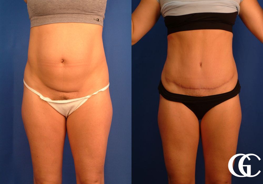 Tummy Tuck - Case 7019