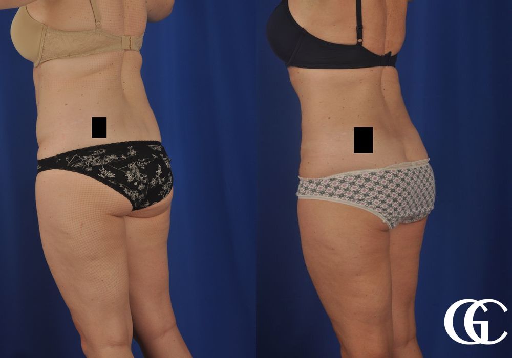 Tummy Tuck - Thumbnail 3