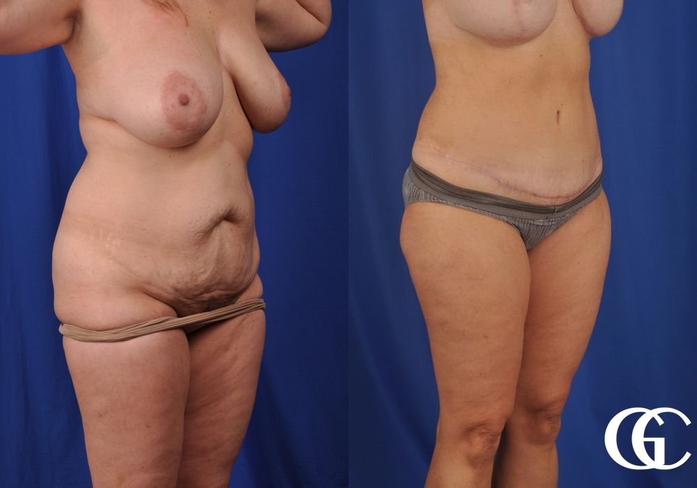 Tummy Tuck - Thumbnail 3