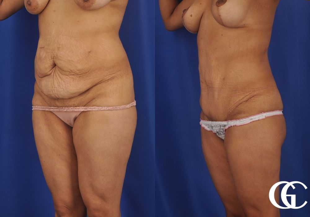 Tummy Tuck - Thumbnail 2