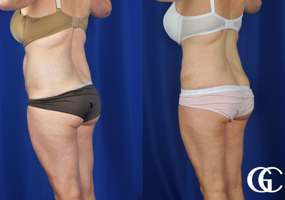 Tummy Tuck - Thumbnail 5