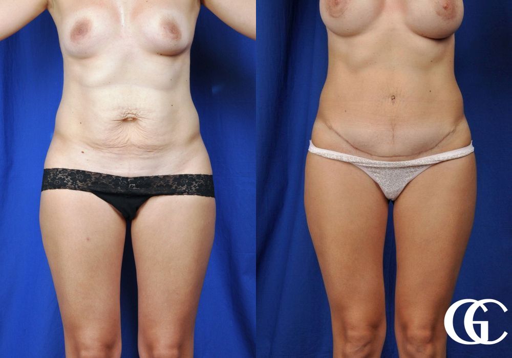 Tummy Tuck - Case 6987