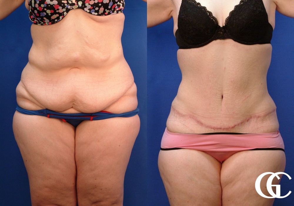 Tummy Tuck - Case 6996