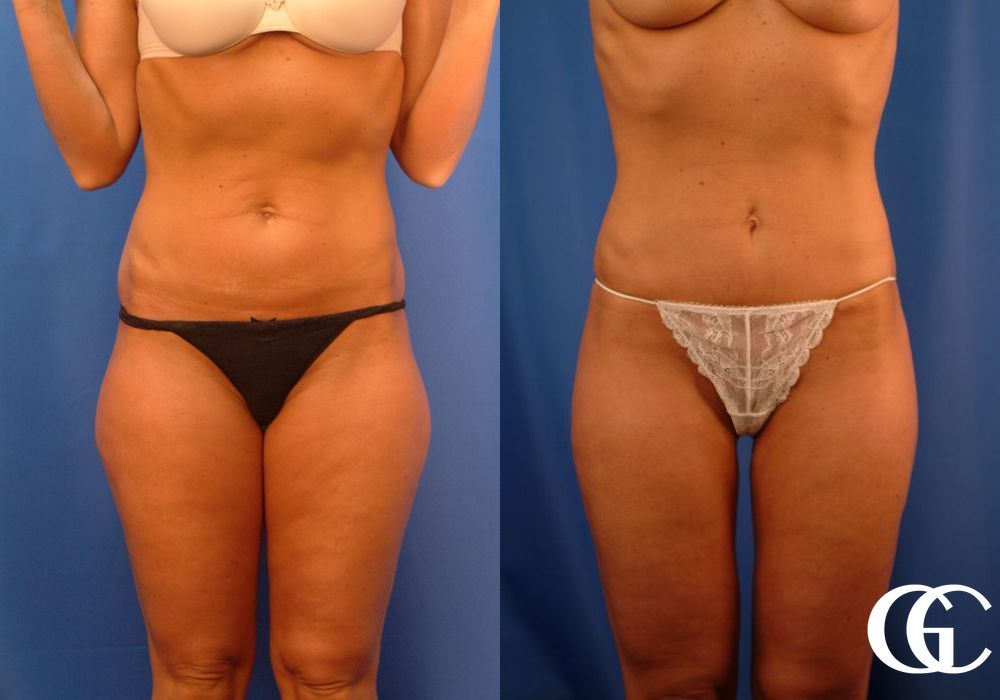 Tummy Tuck - Case 7001