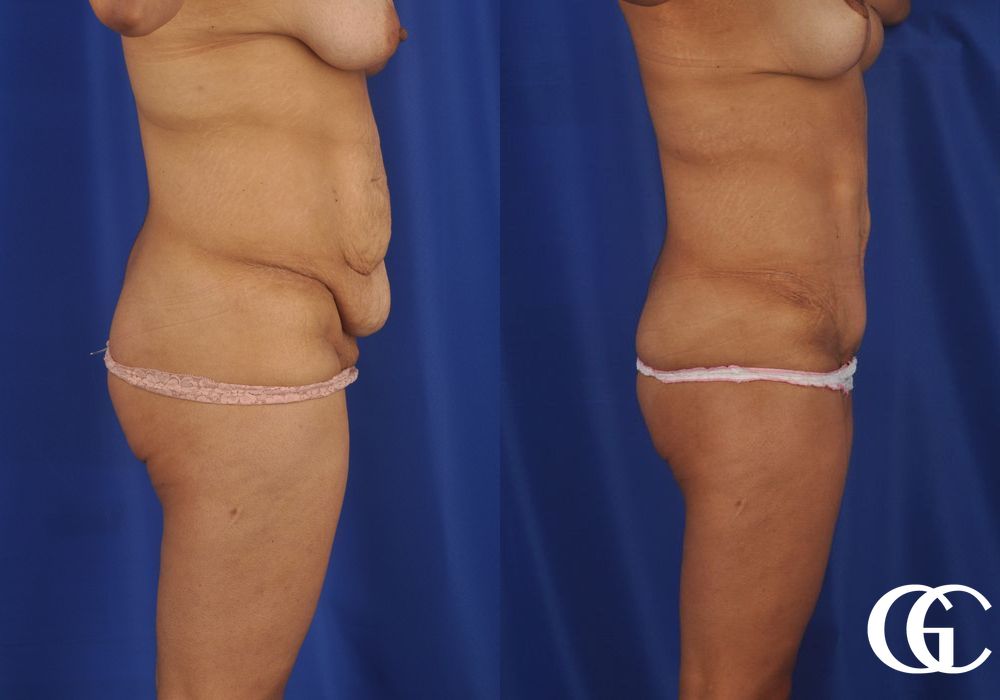 Tummy Tuck - Thumbnail 4