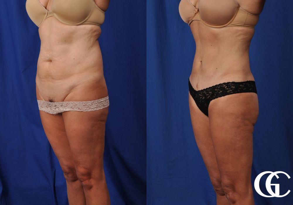 Tummy Tuck - Thumbnail 3