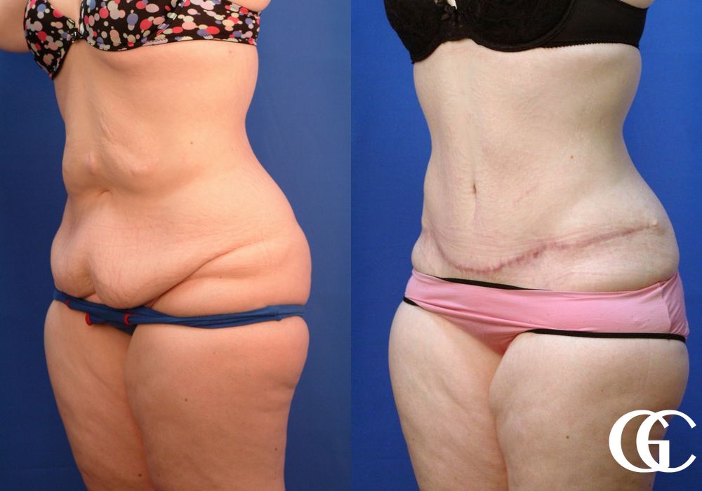 Tummy Tuck - Thumbnail 3