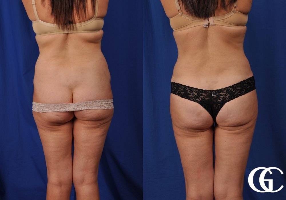 Tummy Tuck - Thumbnail 5