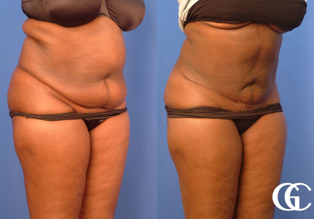 Tummy Tuck - Thumbnail 2