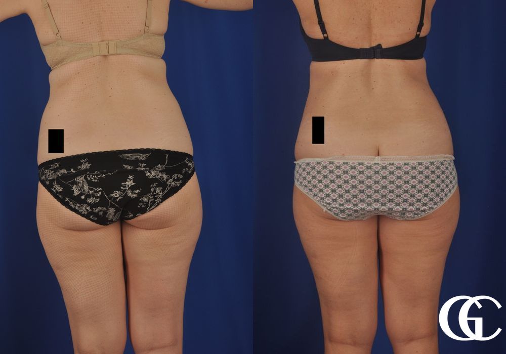 Tummy Tuck - Thumbnail 2