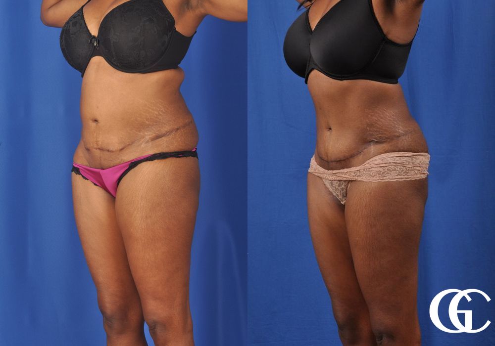 Tummy Tuck - Thumbnail 4