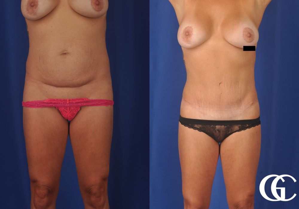Tummy Tuck - Case 7015