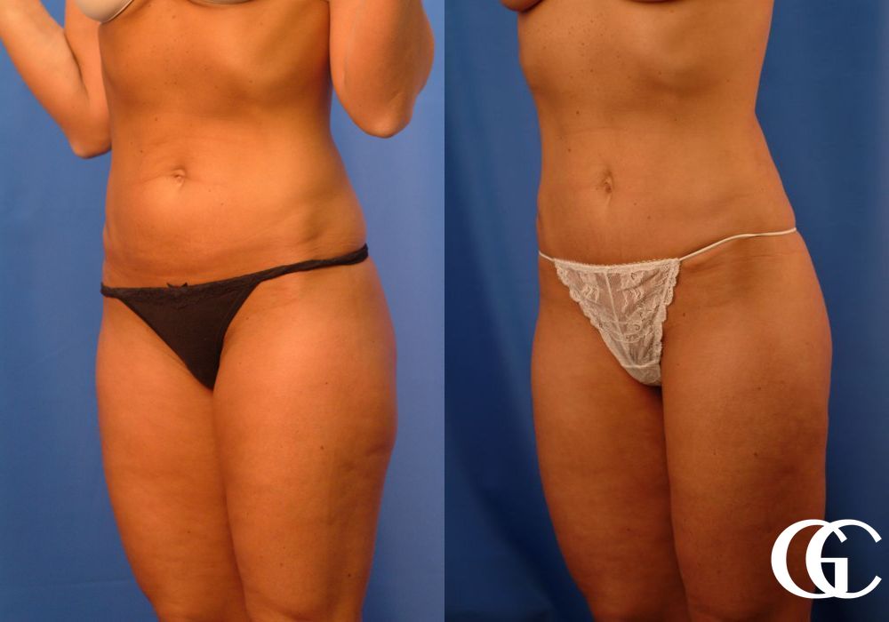 Tummy Tuck - Thumbnail 3