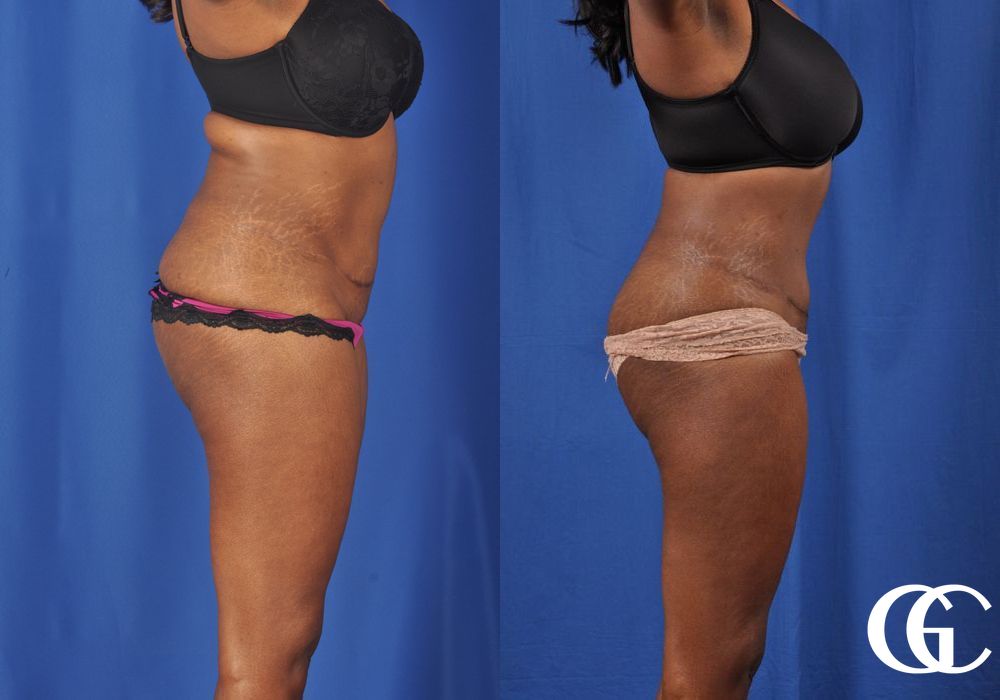 Tummy Tuck - Thumbnail 3