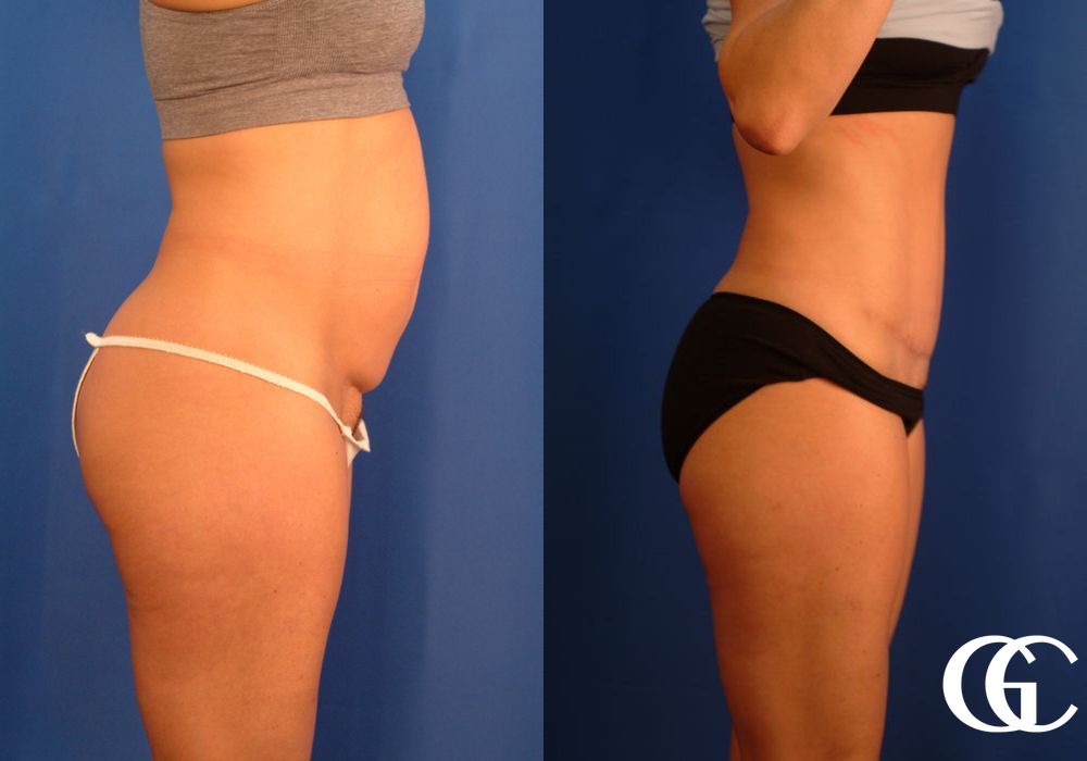 Tummy Tuck - Thumbnail 3