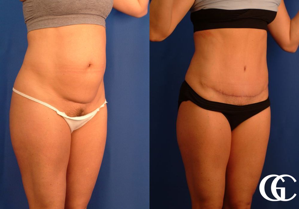 Tummy Tuck - Thumbnail 2