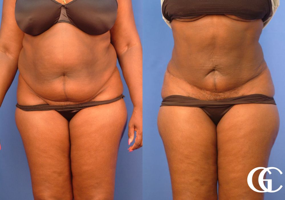 Tummy Tuck - Case 7000
