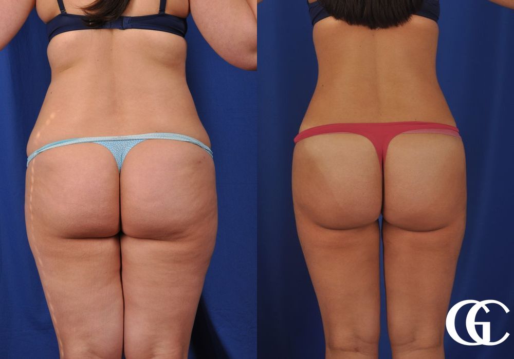 VASER® Lipo - Thumbnail 5