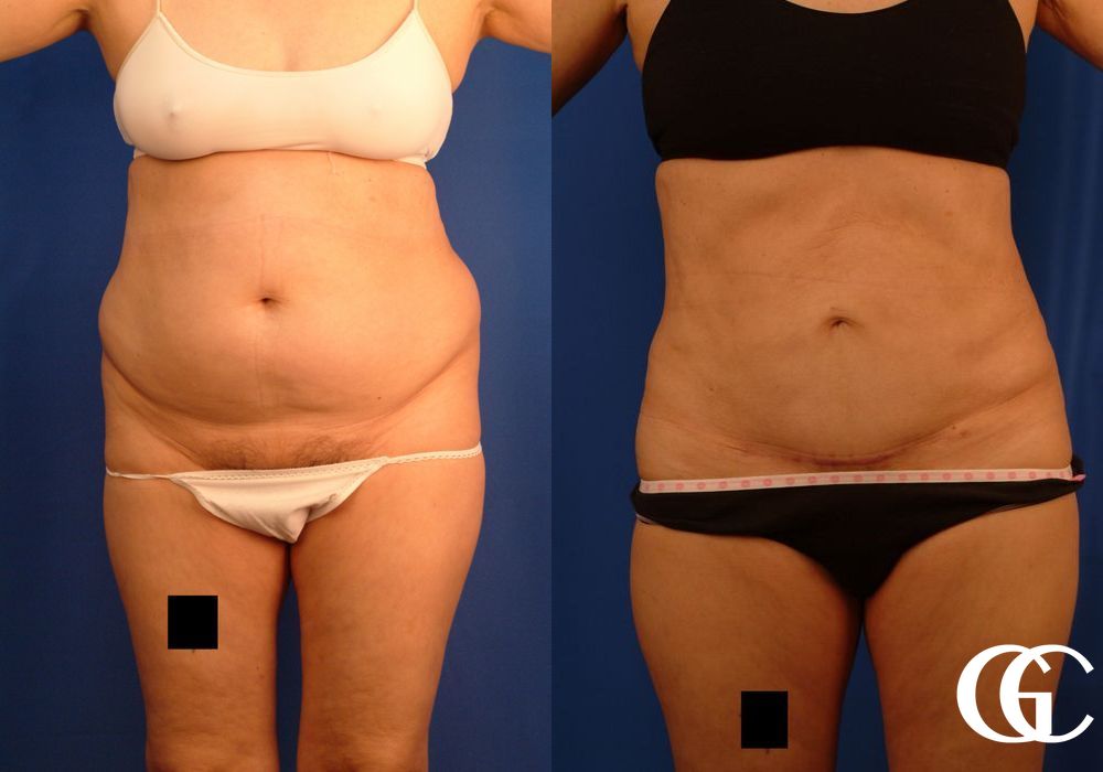 VASER® Lipo - Case 7027