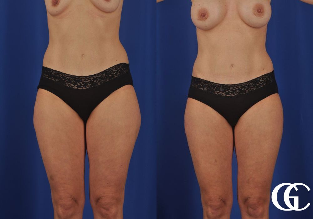 VASER® Lipo - Case 7033