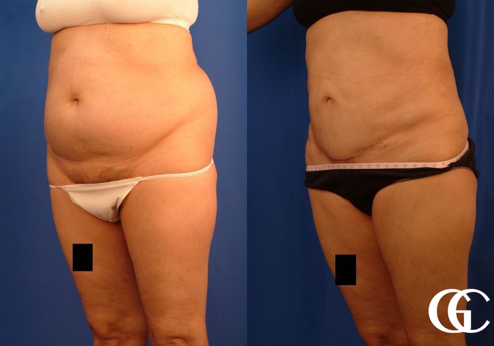 VASER® Lipo - Thumbnail 3