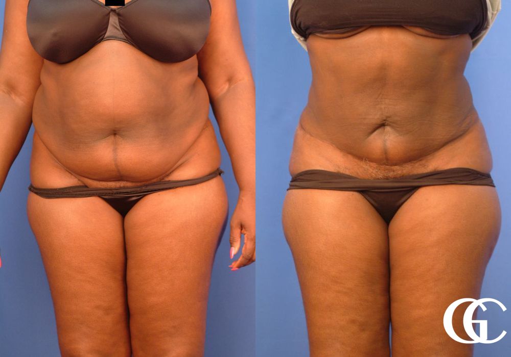 VASER® Lipo - Case 7028