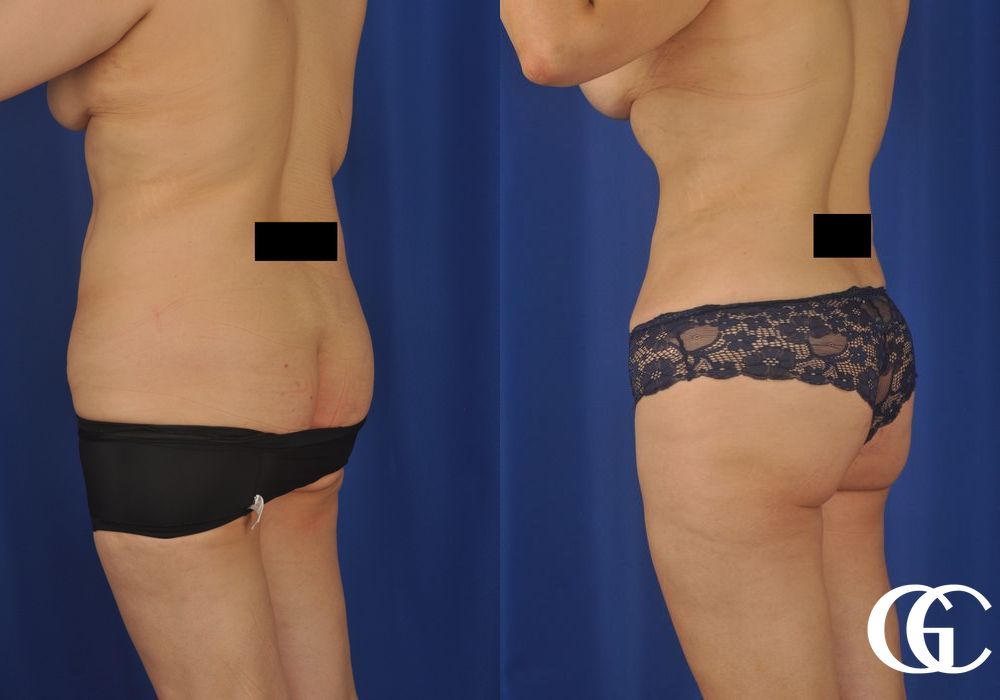 VASER® Lipo - Thumbnail 3