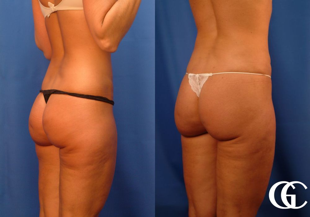 VASER® Lipo - Thumbnail 2