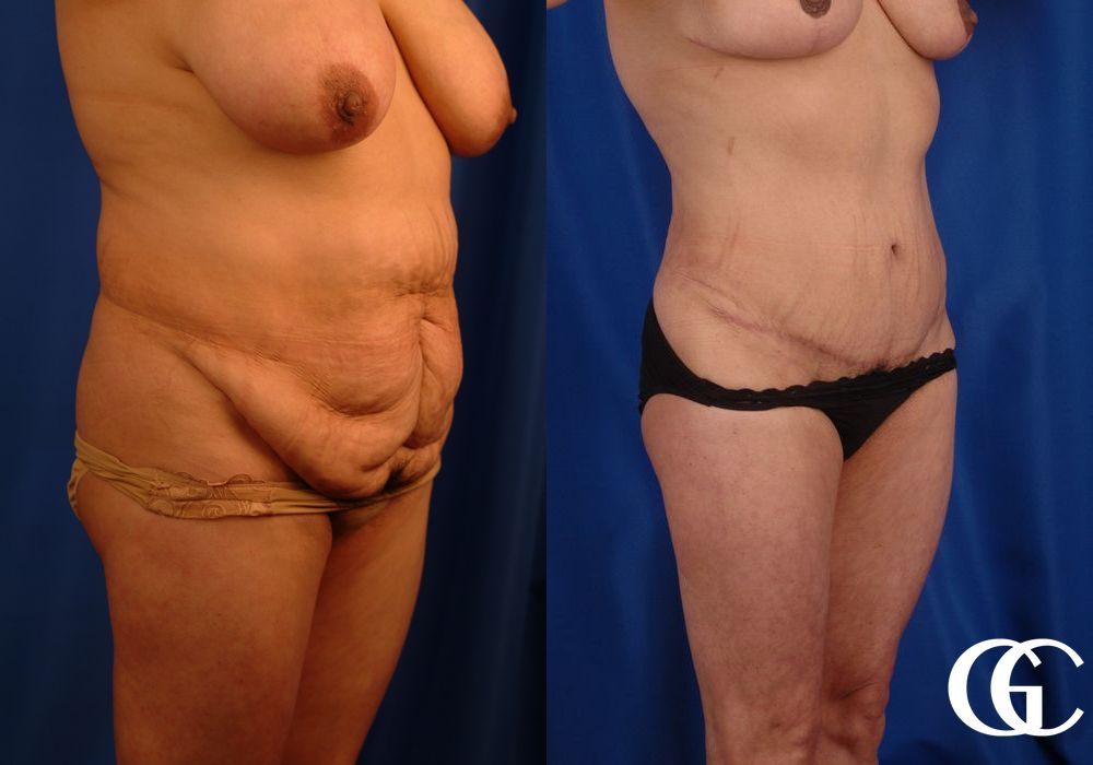 VASER® Lipo - Thumbnail 3