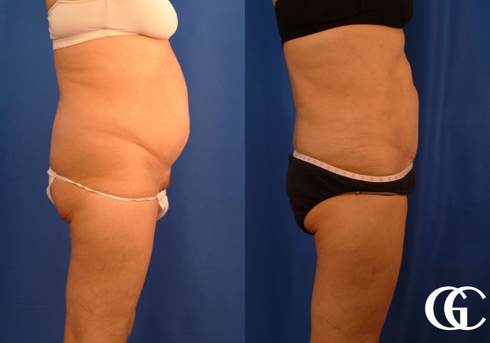 VASER® Lipo - Thumbnail 4