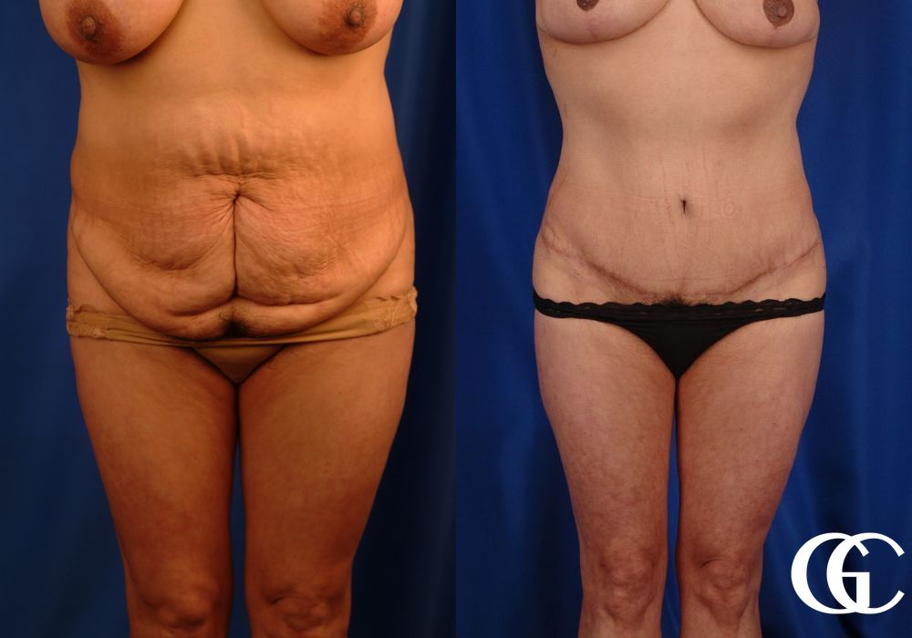 VASER® Lipo - Case 7030