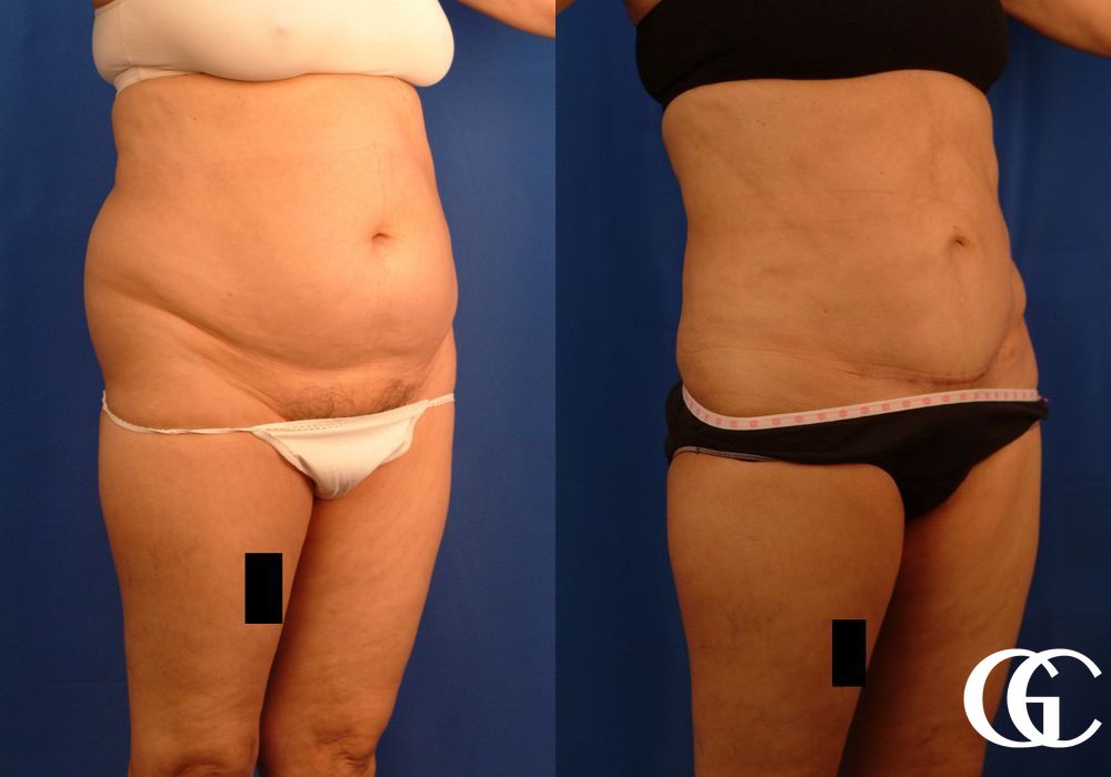 VASER® Lipo - Thumbnail 2