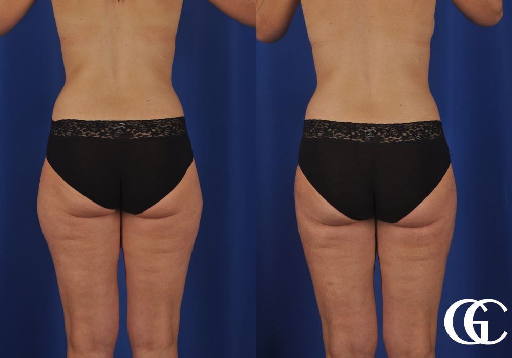 VASER® Lipo - Thumbnail 3