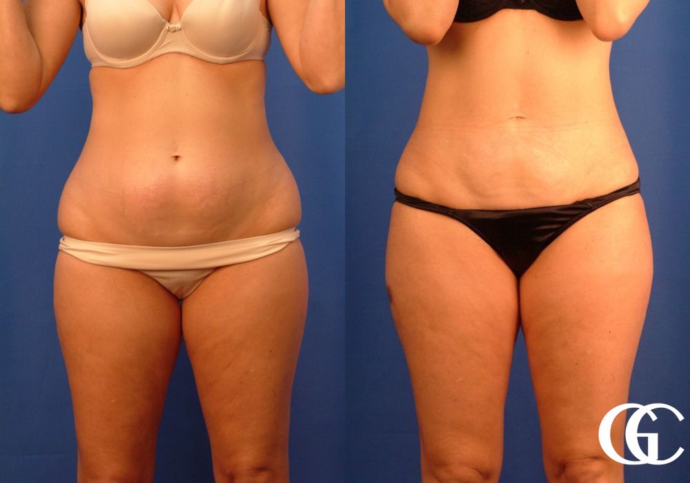 VASER® Lipo - Case 7026