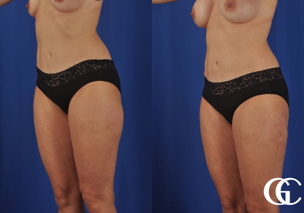 VASER® Lipo - Thumbnail 2