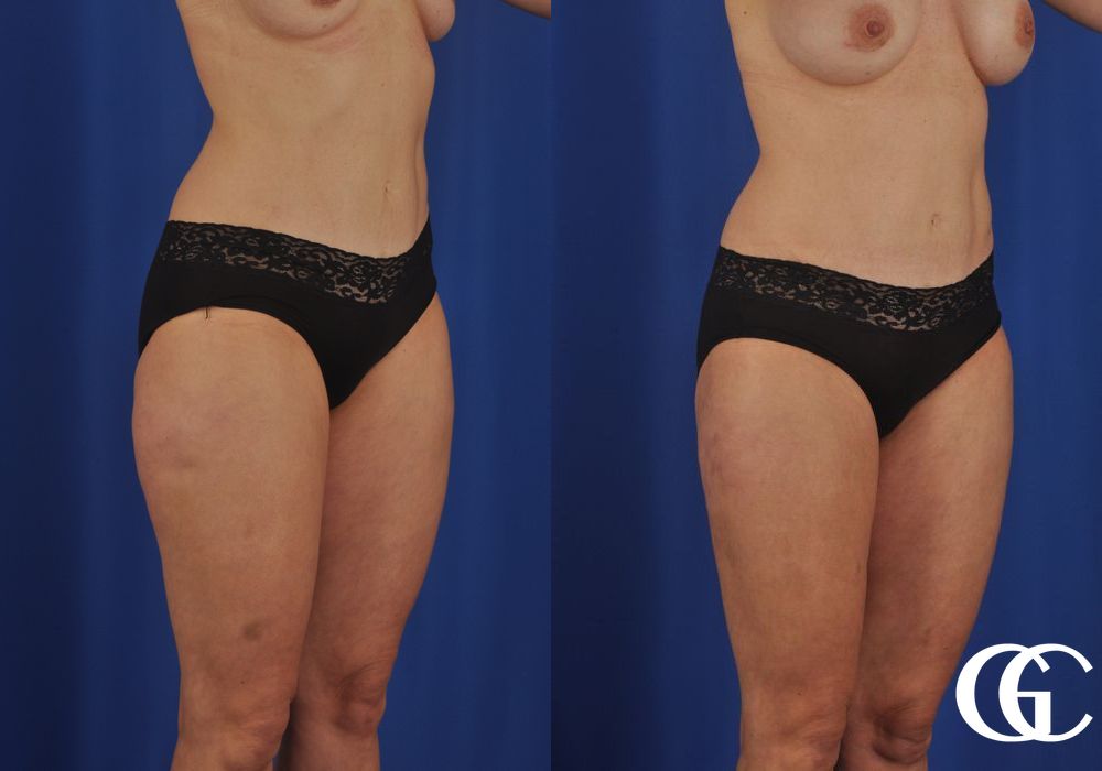 VASER® Lipo - Thumbnail 4