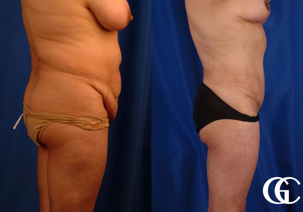 VASER® Lipo - Thumbnail 2