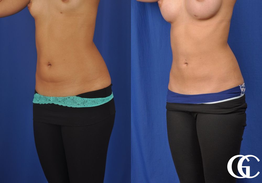 Liposuction - Case 6950