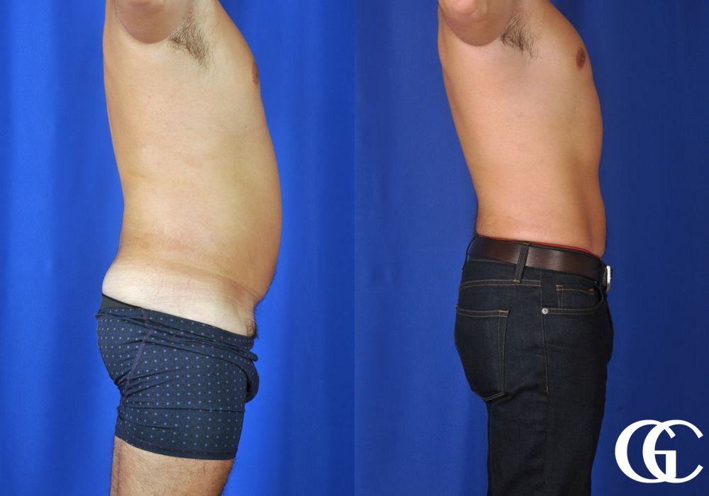 Liposuction - Case 6956