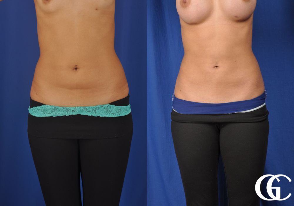 Liposuction - Thumbnail 2