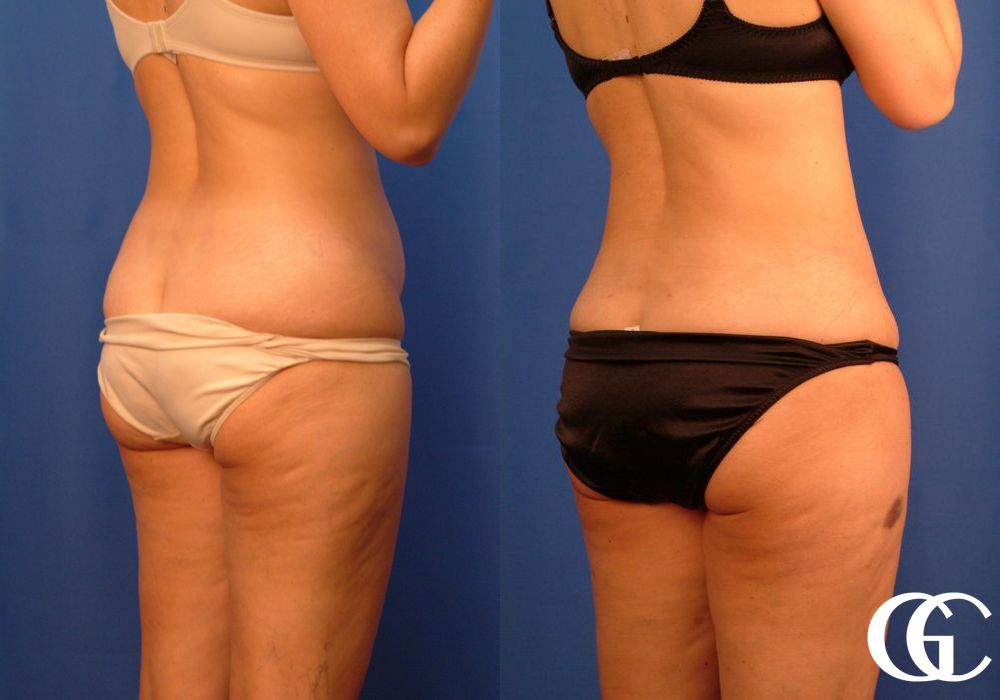 VASER® Lipo - Case 7026