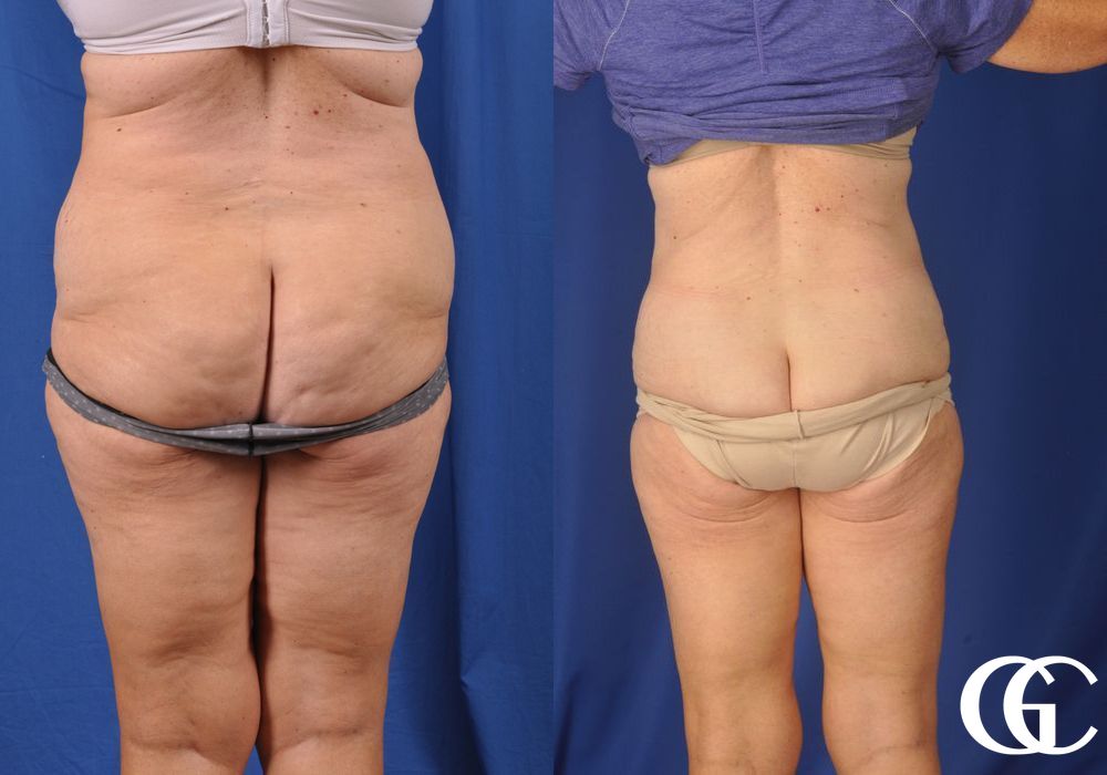 Liposuction - Thumbnail 4
