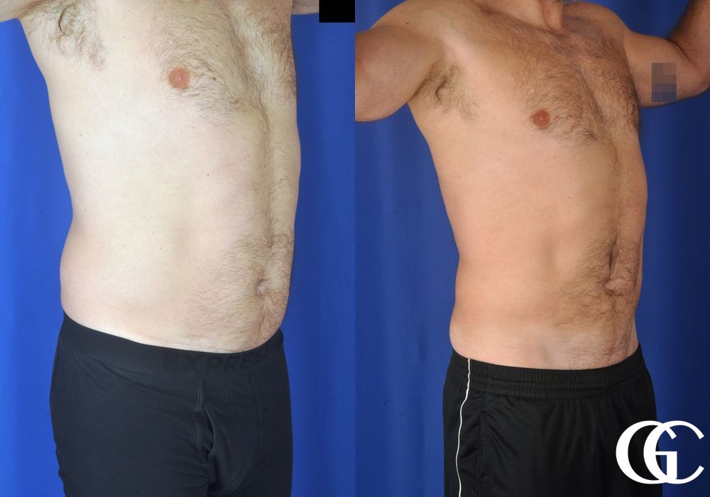 Liposuction - Thumbnail 3