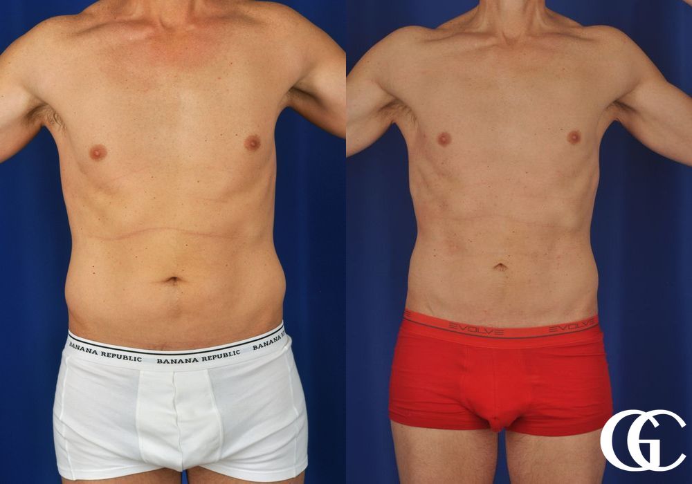 Liposuction - Case 6927