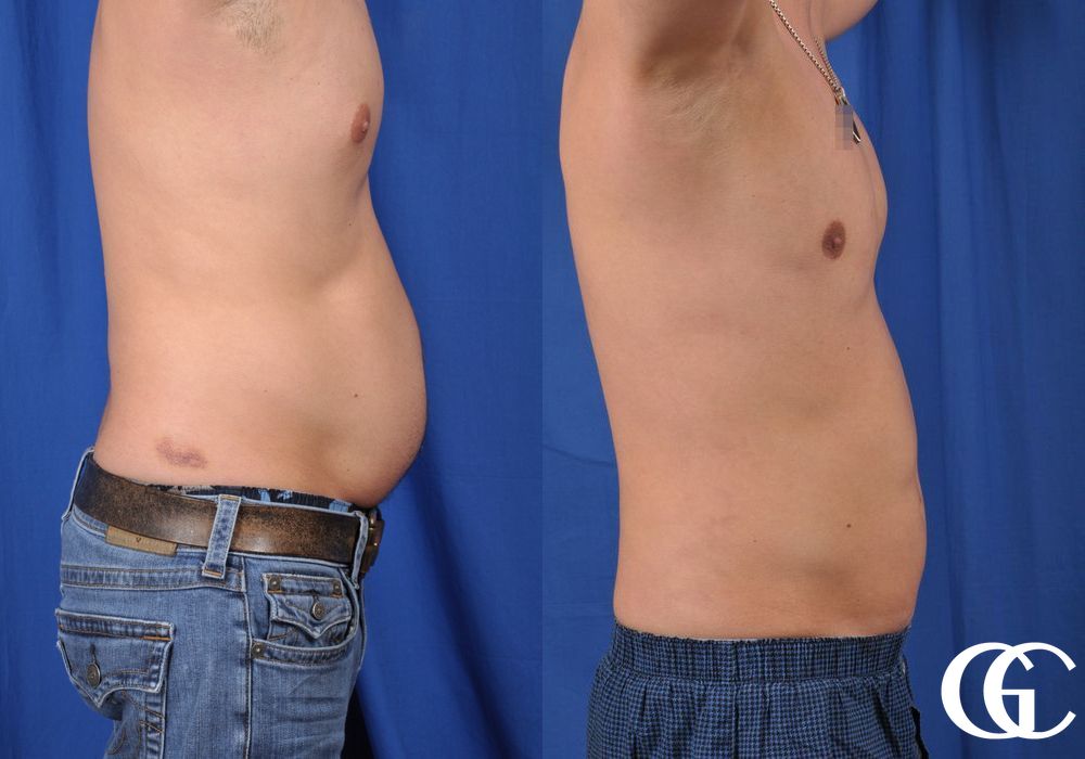 Liposuction - Thumbnail 3