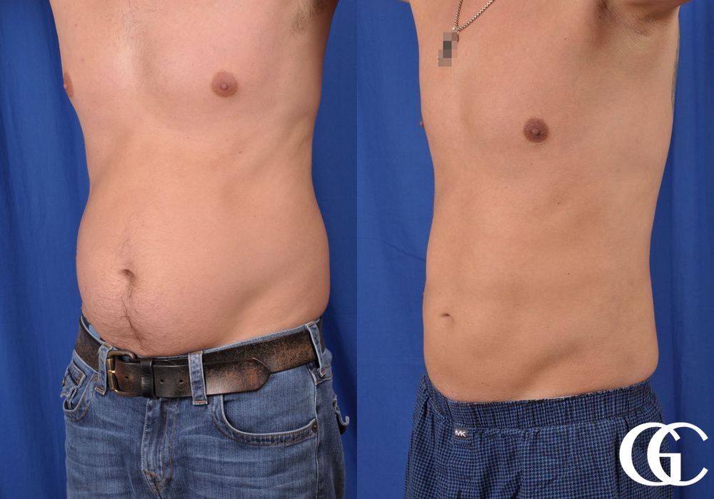 Liposuction - Thumbnail 5