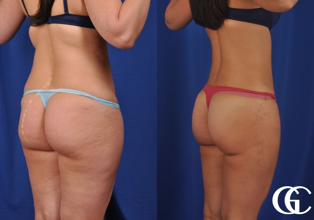 VASER® Lipo - Thumbnail 5